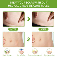 Thumbnail for Silicone Scar Sheets