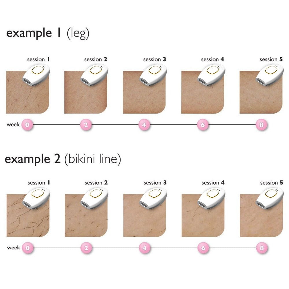 IPL device packaging