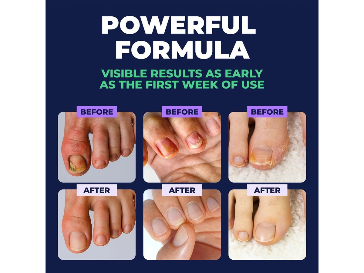 Orivelle Antifungal Pen