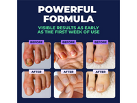 Thumbnail for Orivelle Antifungal Pen